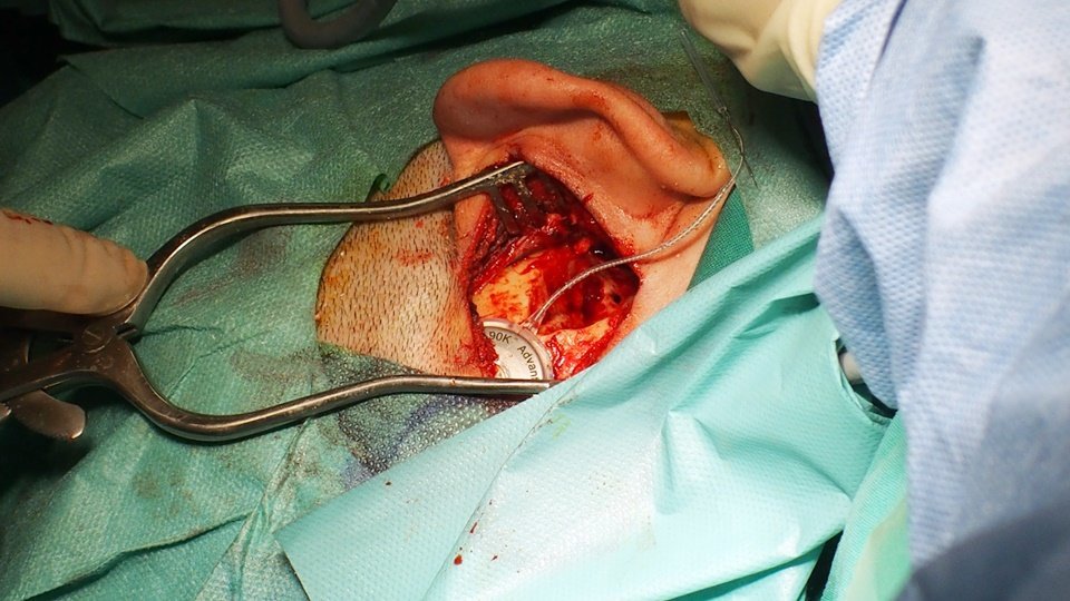 implante operación ingesa